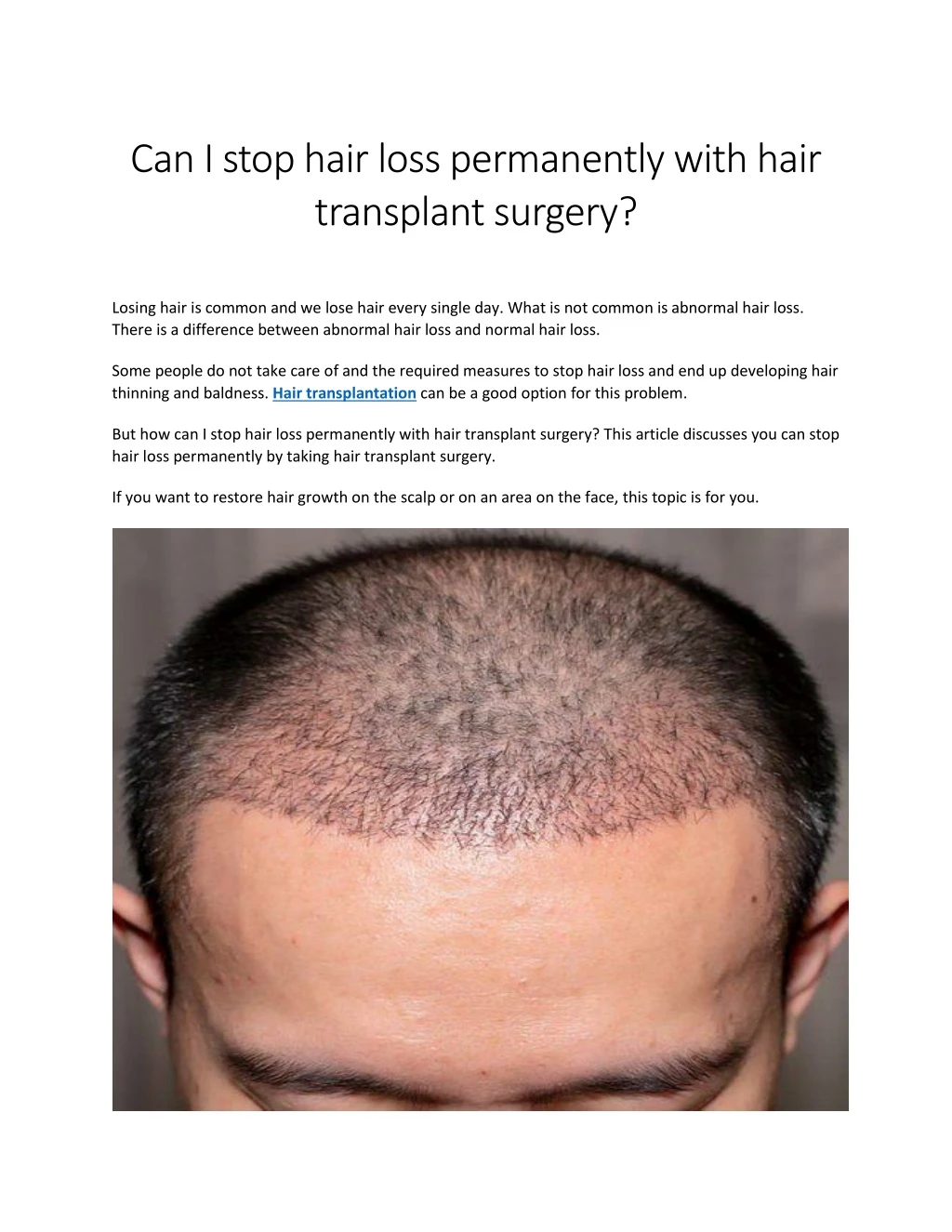can i stop hair loss permanently with hair