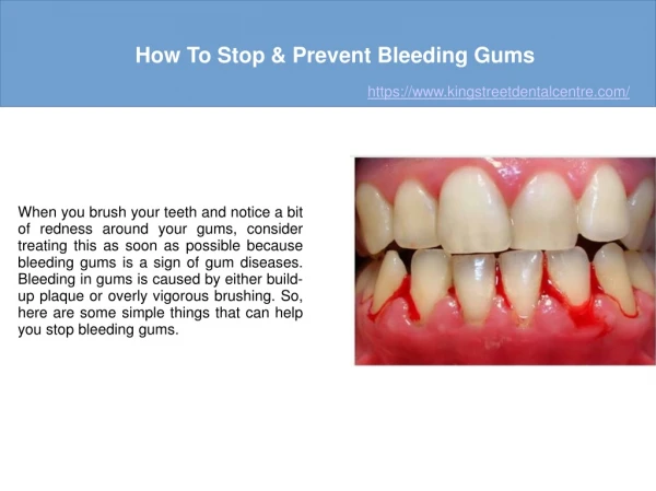 How To Stop & Prevent Bleeding Gums