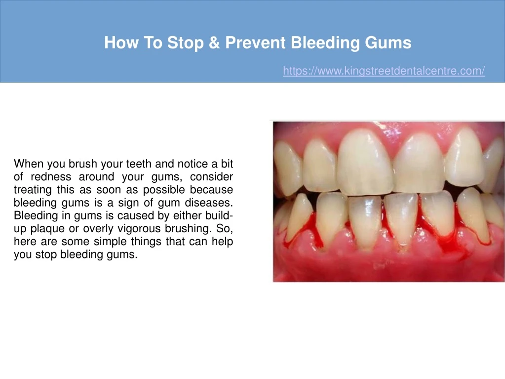 how to stop prevent bleeding gums