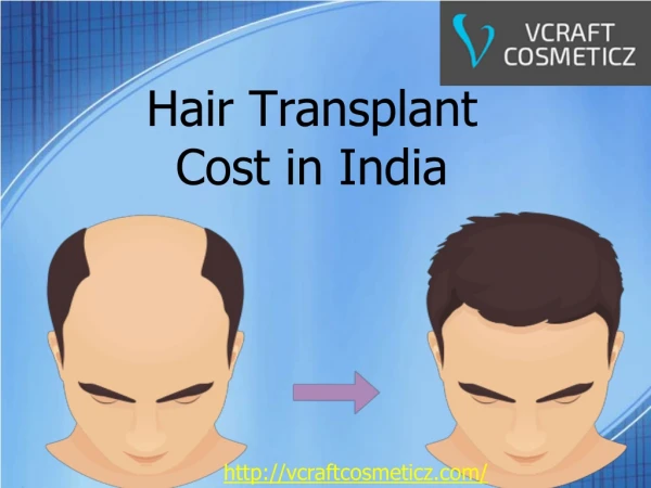 Hair Transplant Cost in India - VcraftCosmeticz