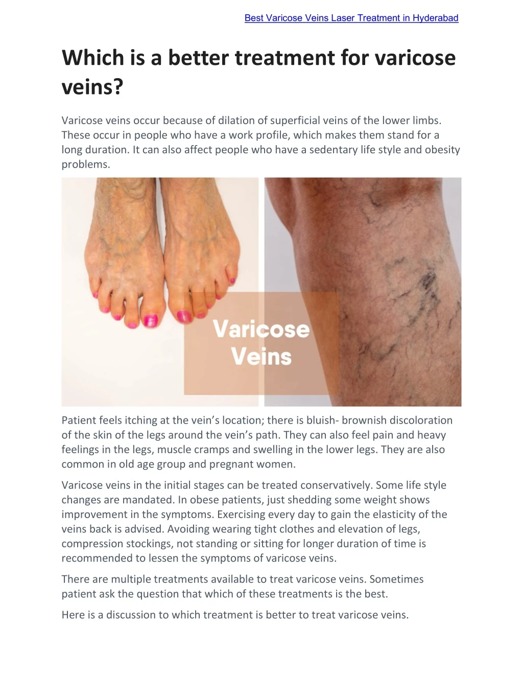 best varicose veins laser treatment in hyderabad