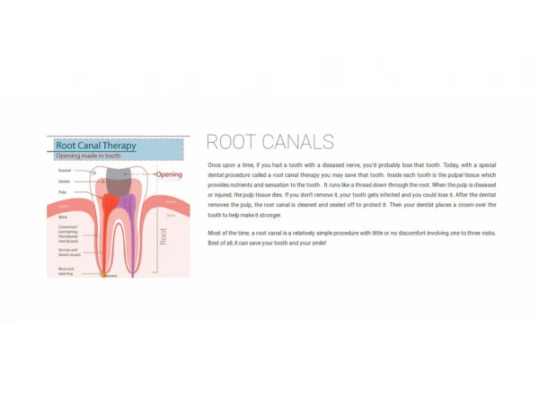 Root Canals in Marine City