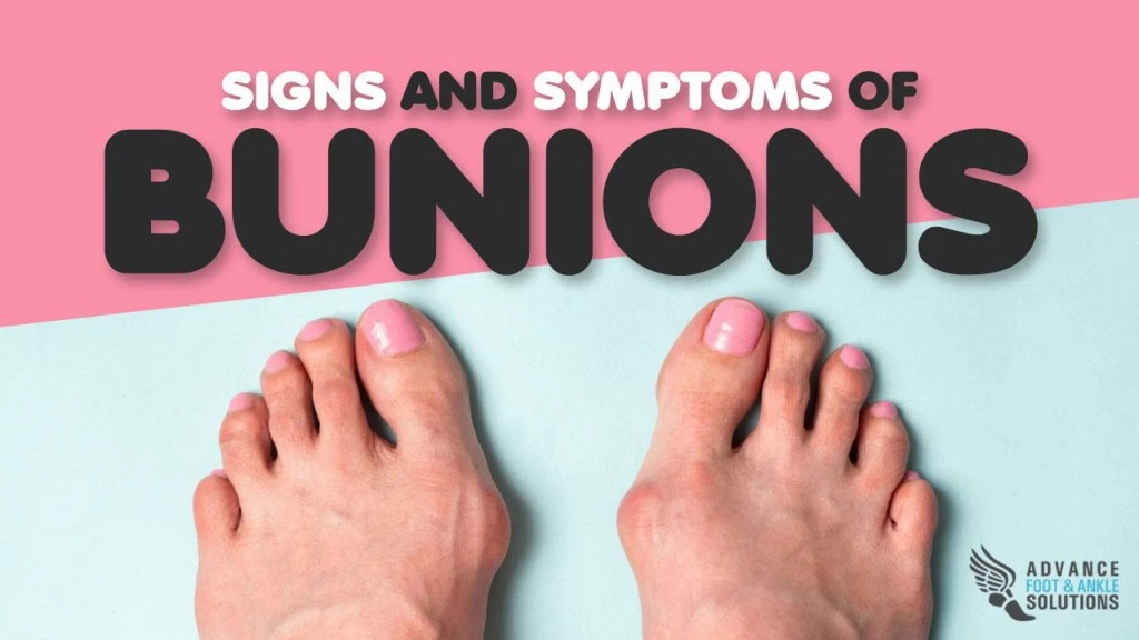 signs and symptoms of bunions