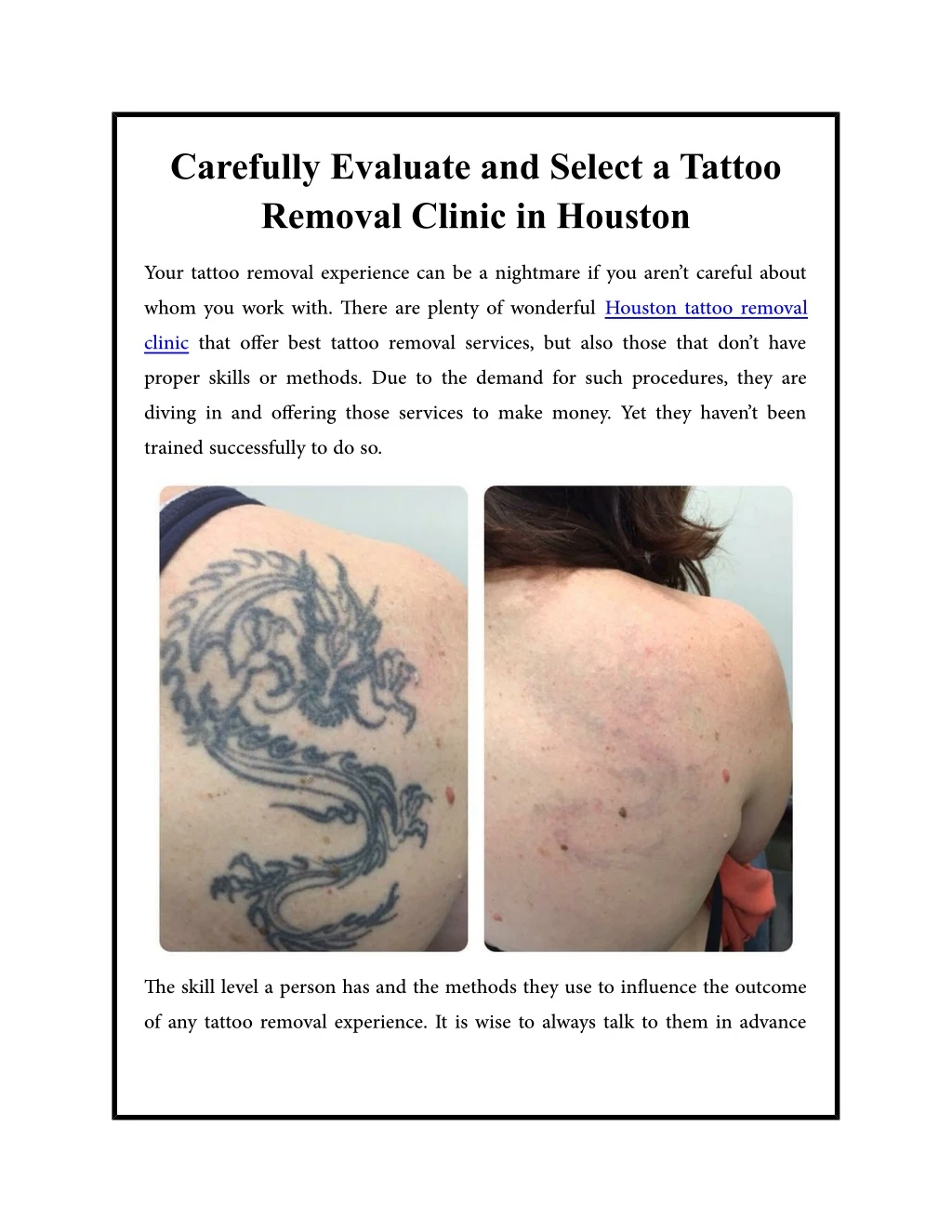 carefully evaluate and select a tattoo removal