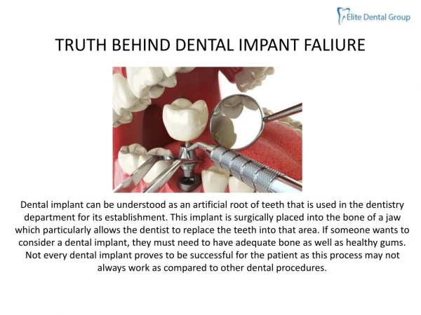 TRUTH BEHIND DENTAL IMPANT FALIURE