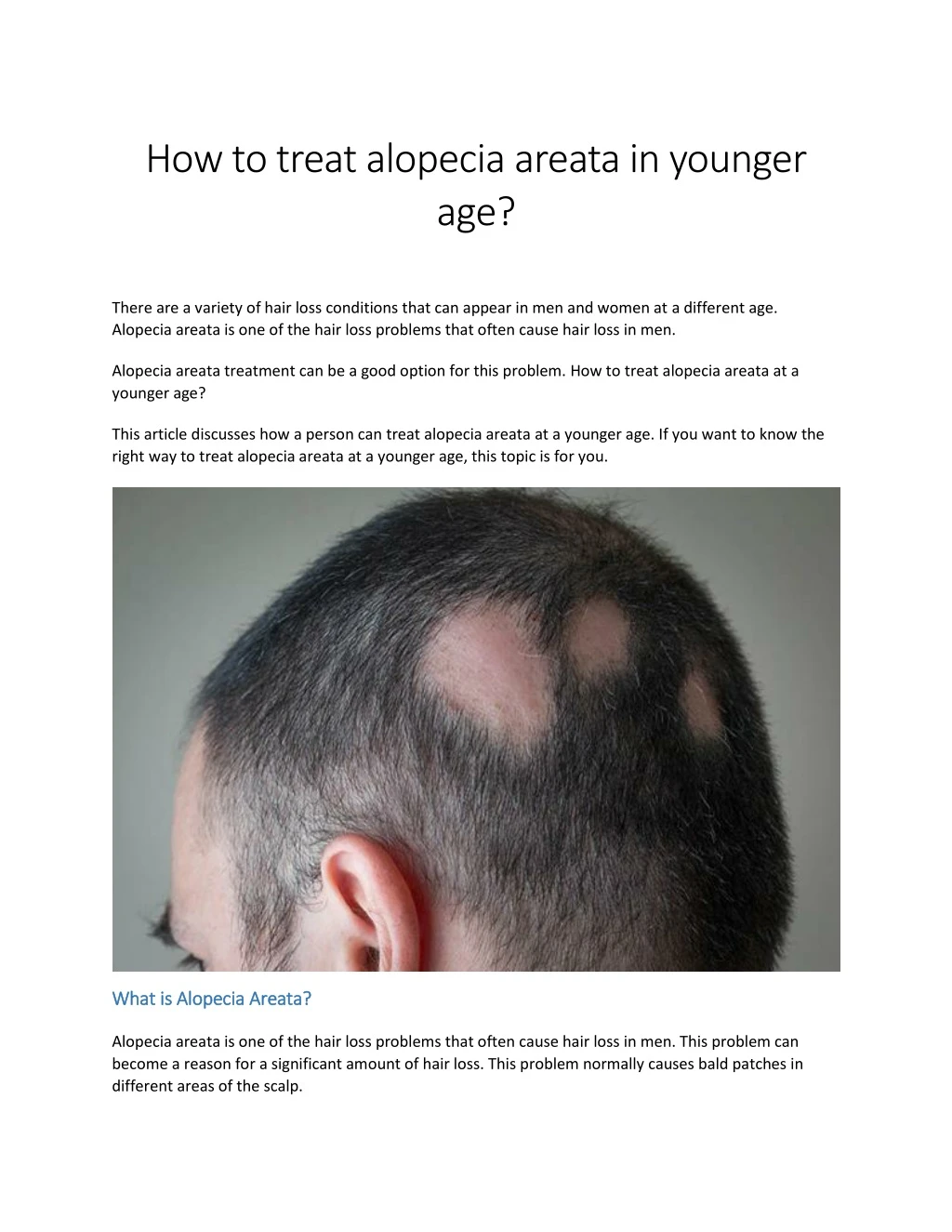 how to treat alopecia areata in younger age