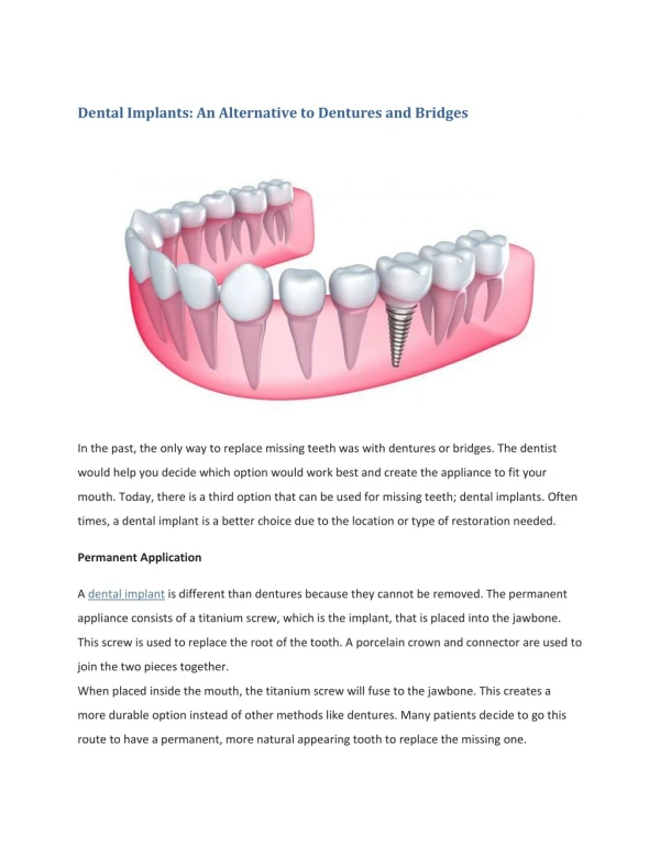Dental Implants: An Alternative to Dentures and Bridges
