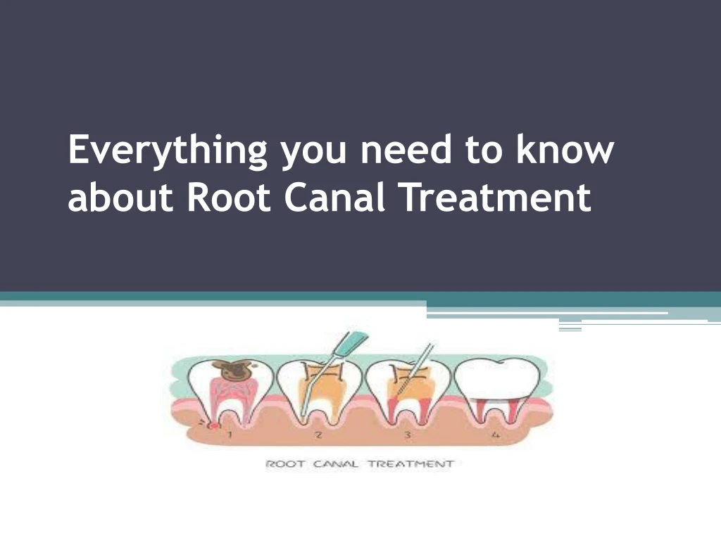 everything you need to know about root canal