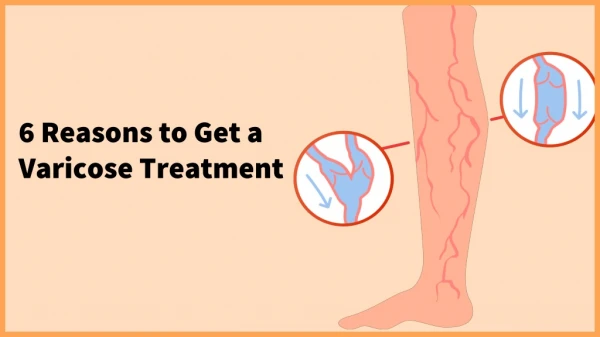 6 Reasons to Get a Varicose Treatment