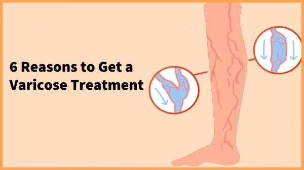 6 reasons to get a varicose treatment