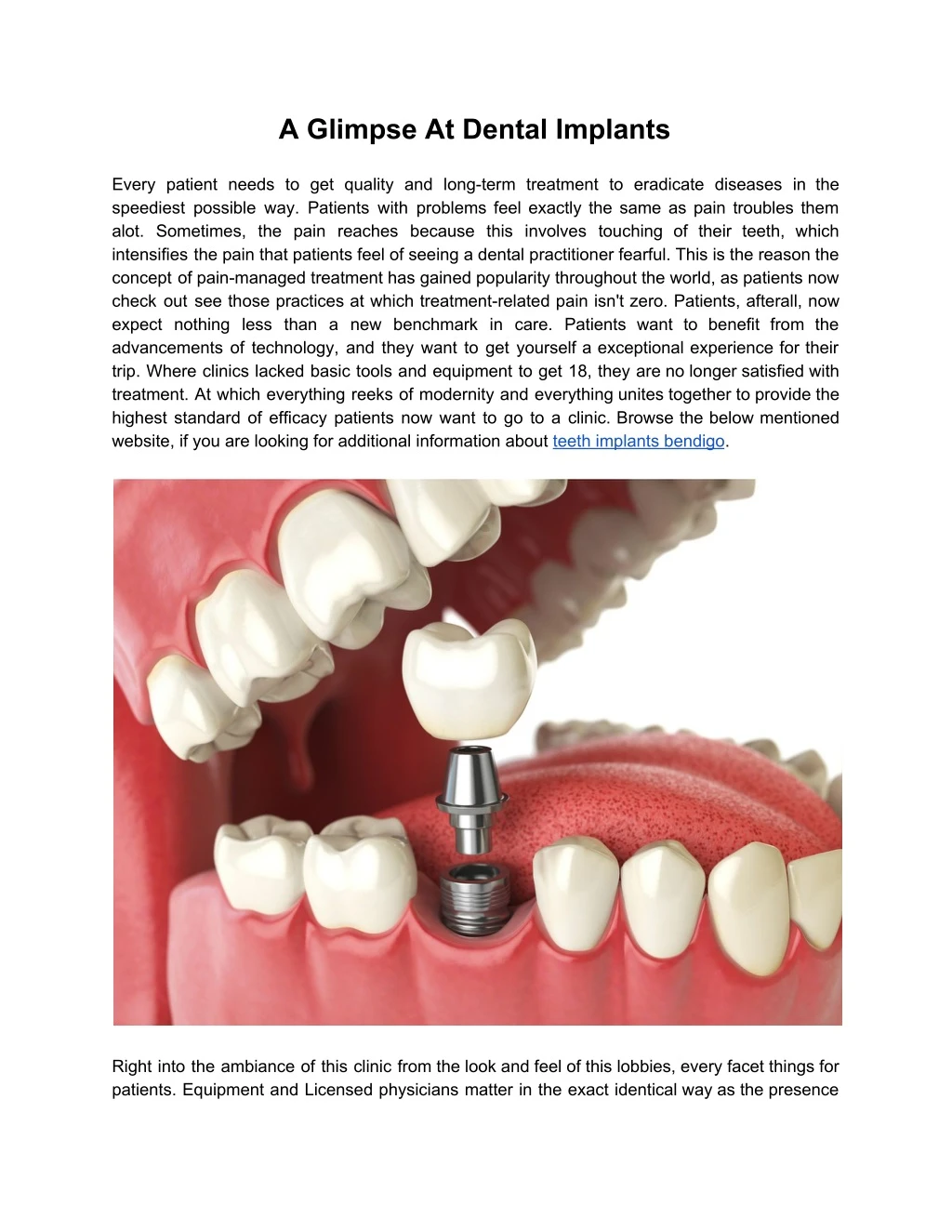 a glimpse at dental implants every patient needs