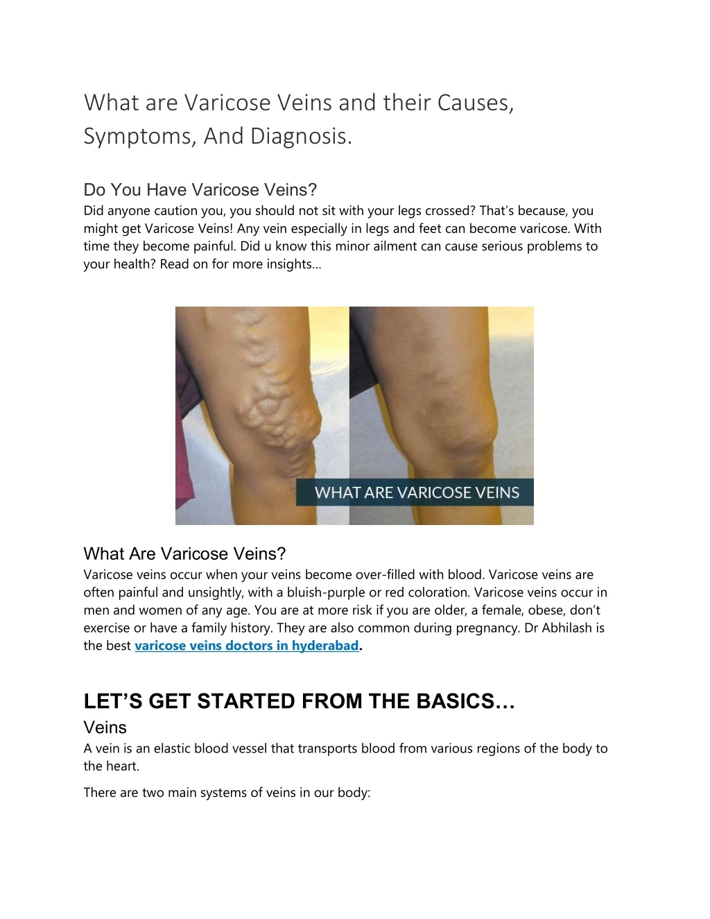 what are varicose veins and their causes symptoms