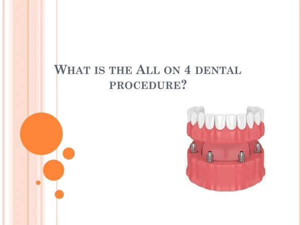 What is the All on 4 dental procedure