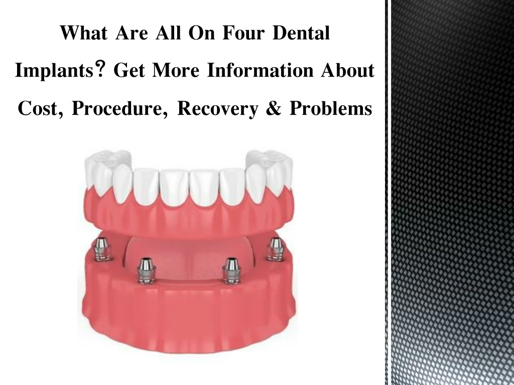 what are all on four dental