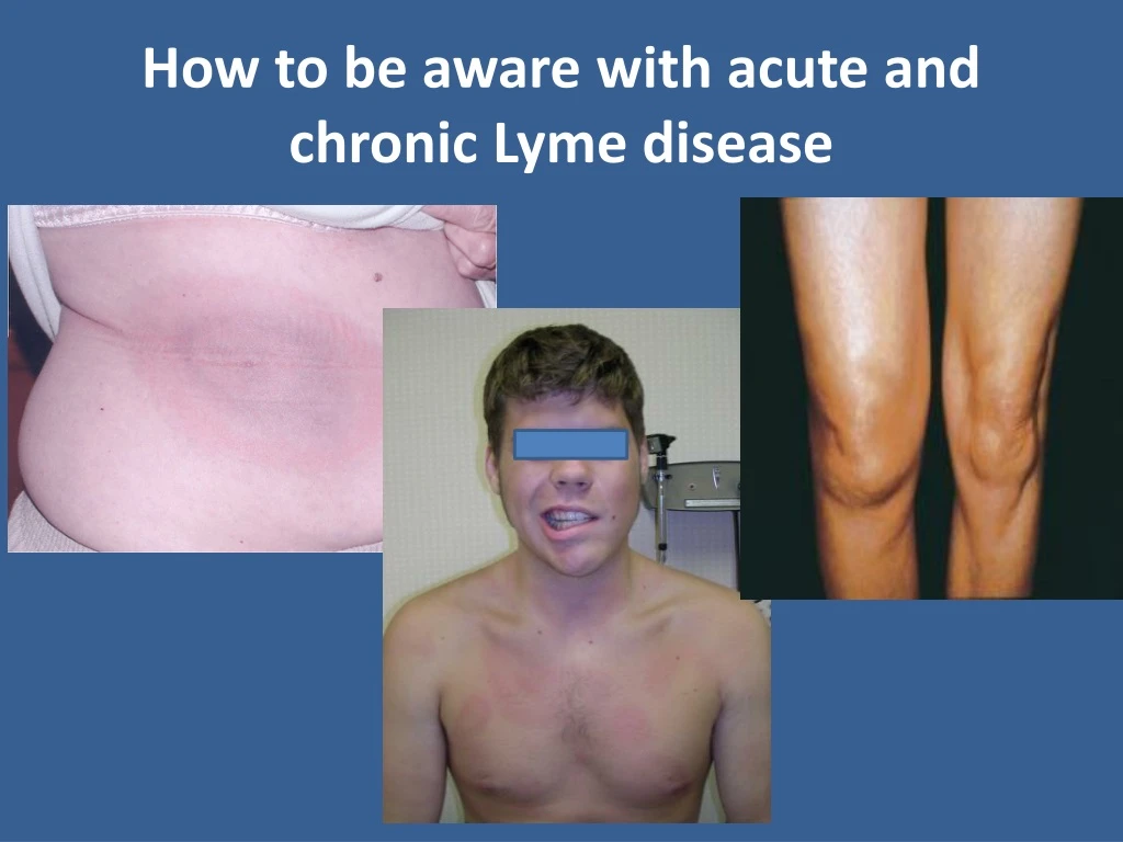 how to be aware with acute and chronic lyme disease