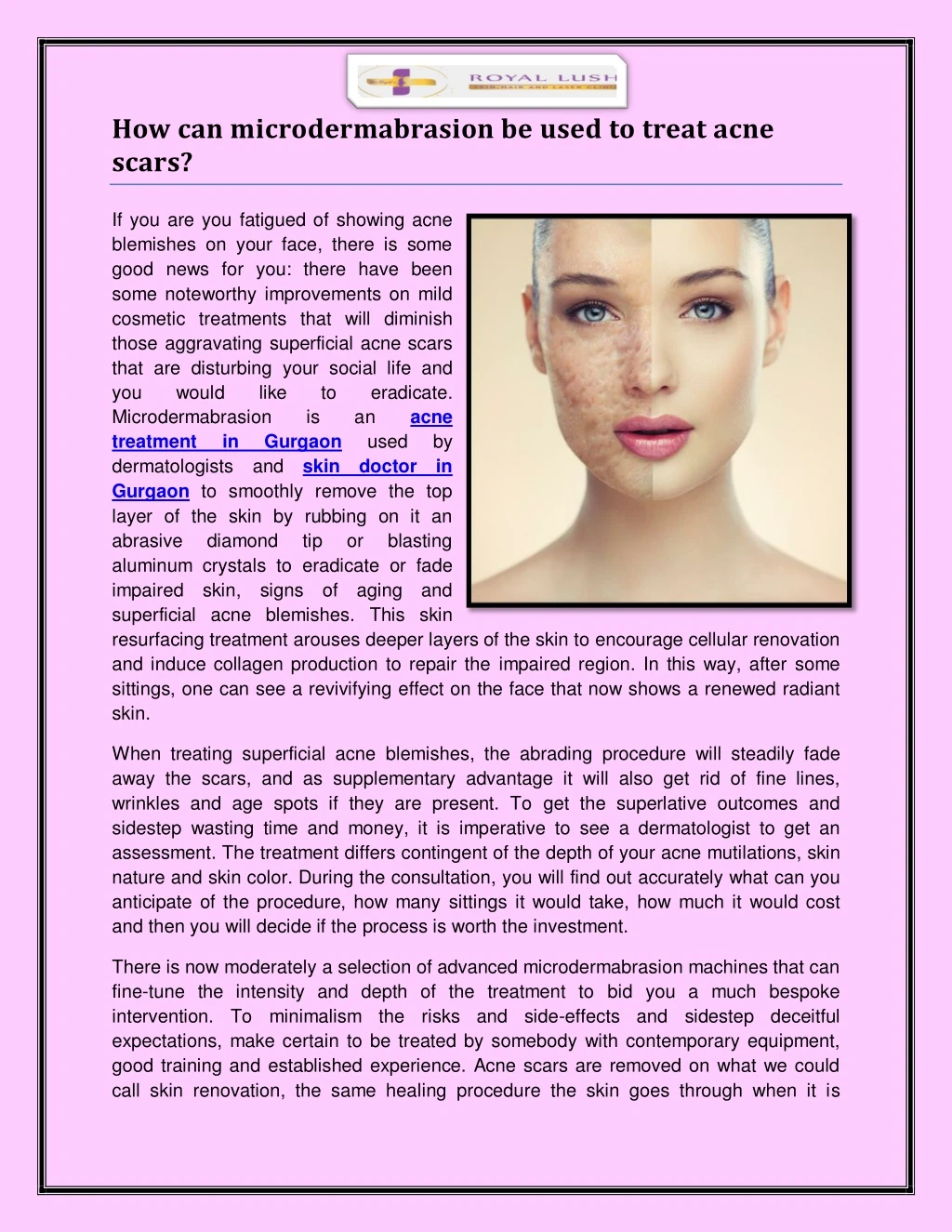 how can microdermabrasion be used to treat acne