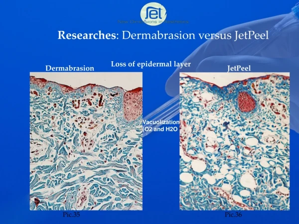 Researches : Dermabrasion versus JetPeel