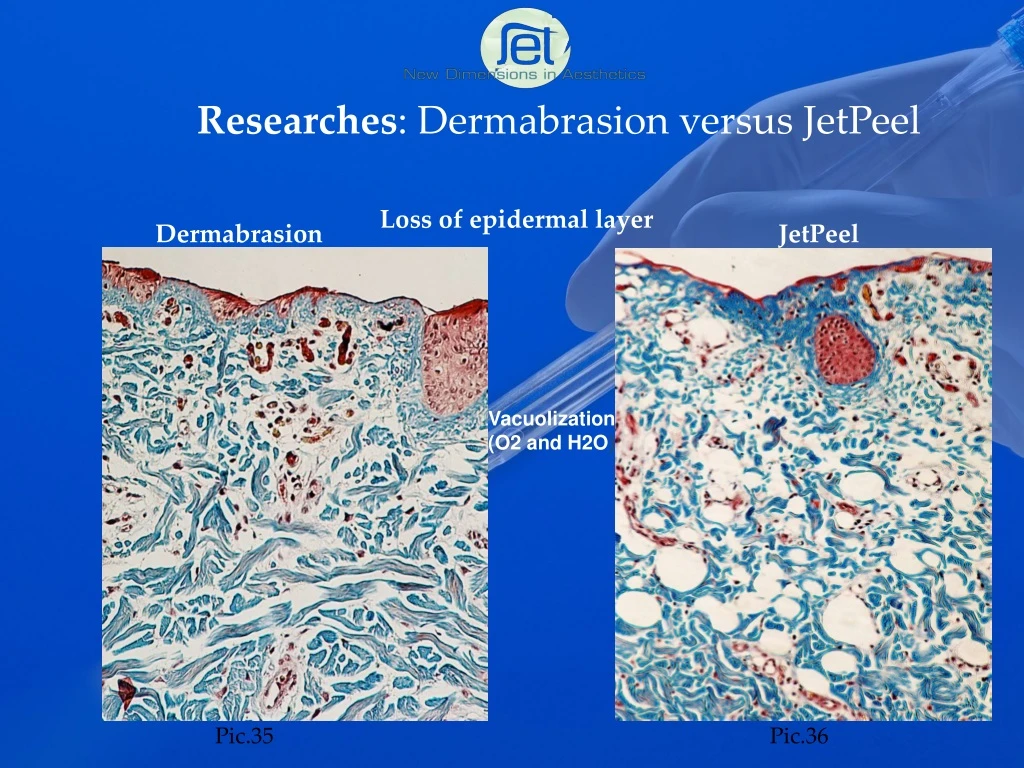 researches dermabrasion versus jetpeel