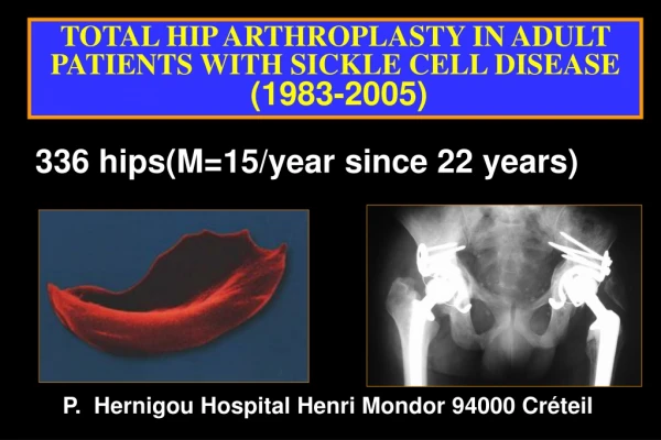 TOTAL HIP ARTHROPLASTY IN ADULT PATIENTS WITH SICKLE CELL DISEASE (1983-2005)