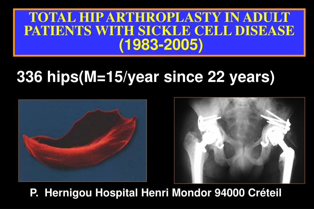 total hip arthroplasty in adult patients with sickle cell disease 1983 2005