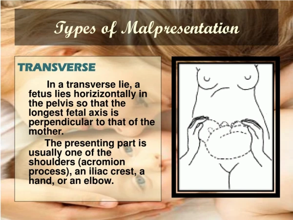 Types of Malpresentation