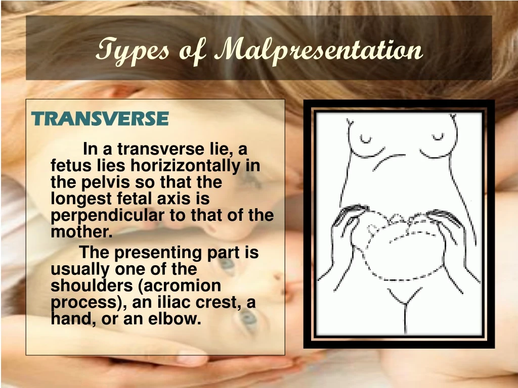 types of malpresentation