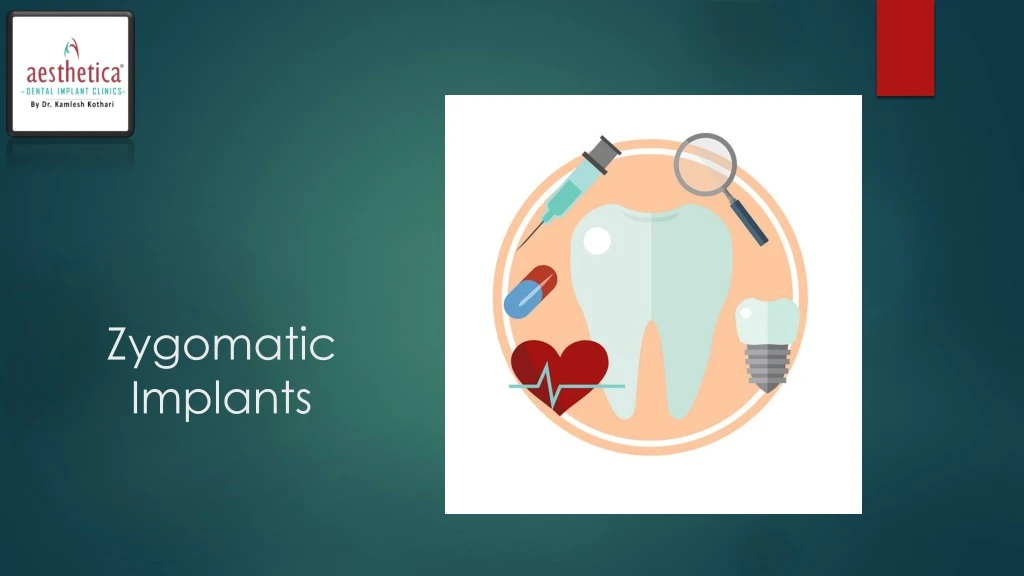 zygomatic implants