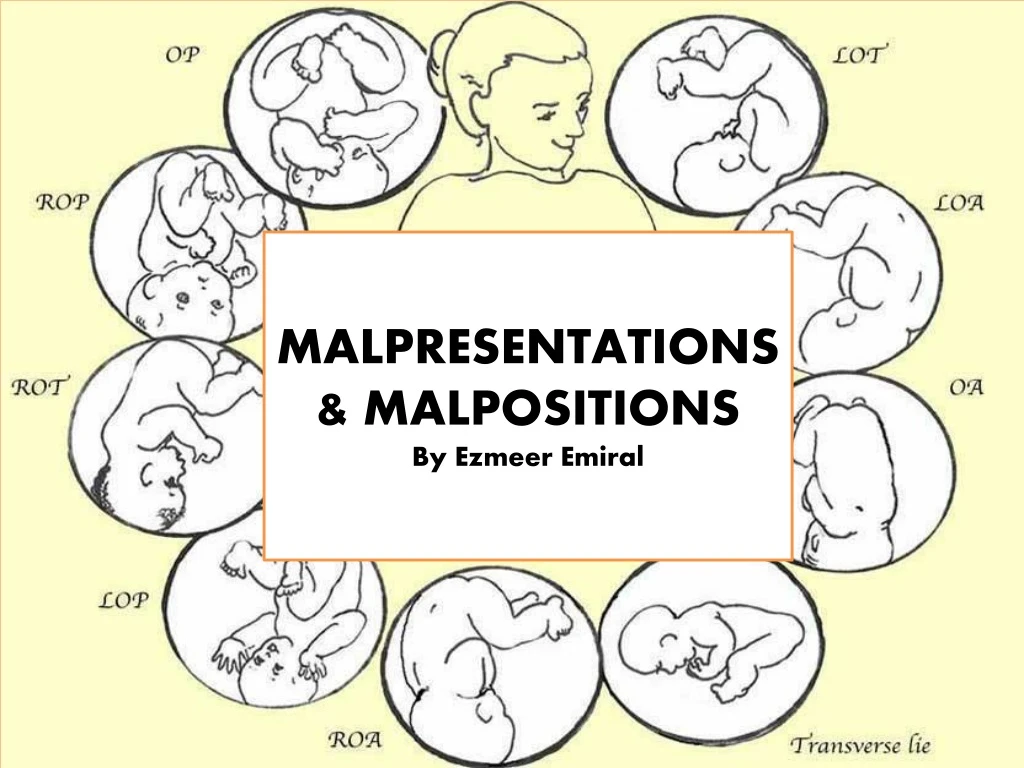 malpresentations malpositions by ezmeer emiral