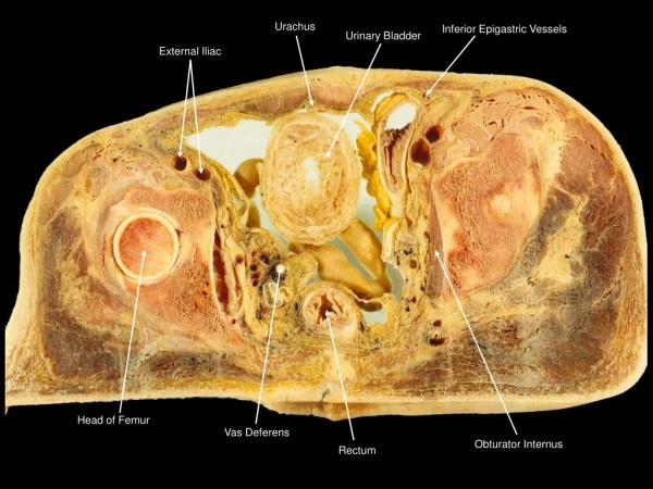 External Iliac