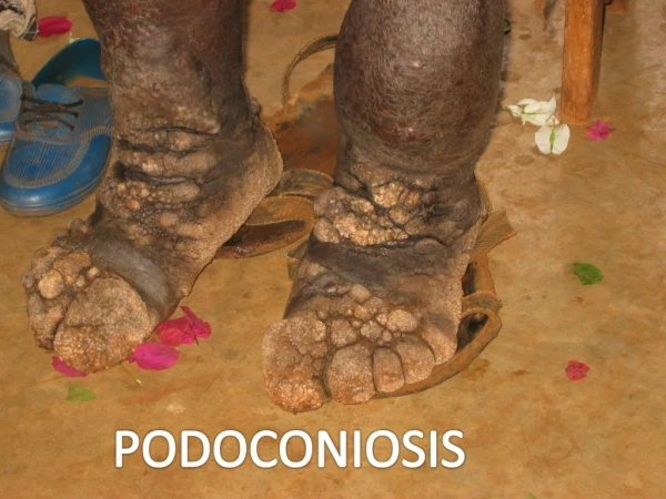 What is Podoconiosis? - 1