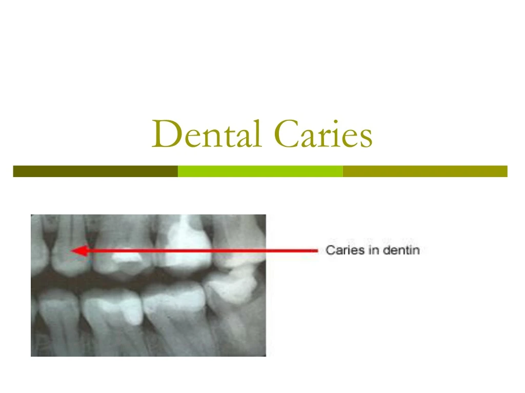 dental caries