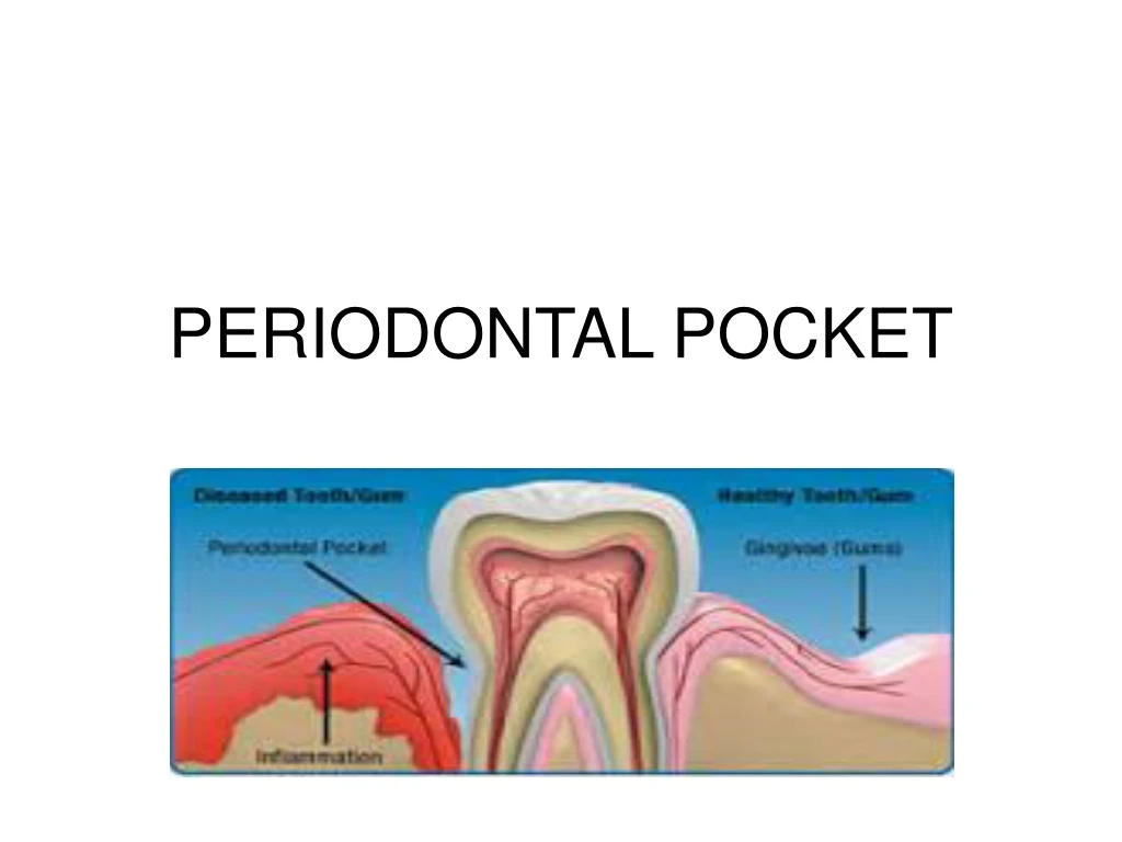 periodontal pocket