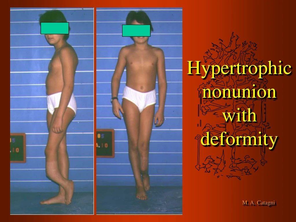 hypertrophic nonunion with deformity