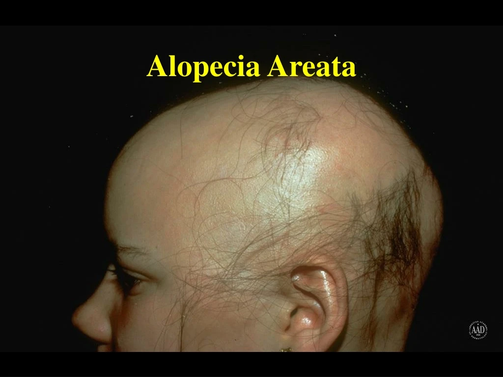 alopecia areata