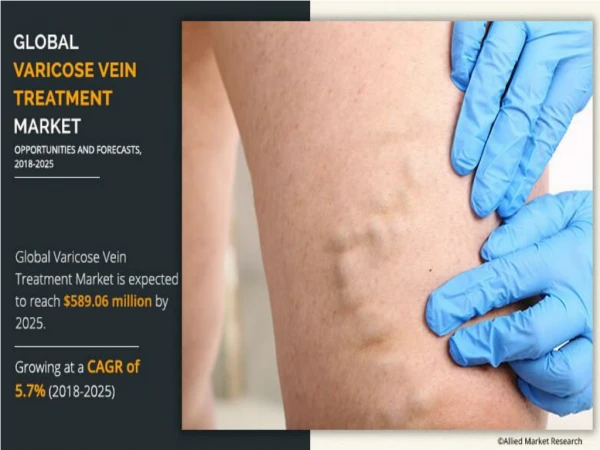 Varicose Vein Treatment Market to Perceive Significant Growth by 2026 with a CAGR over 5.7% from 2018 to 2025.