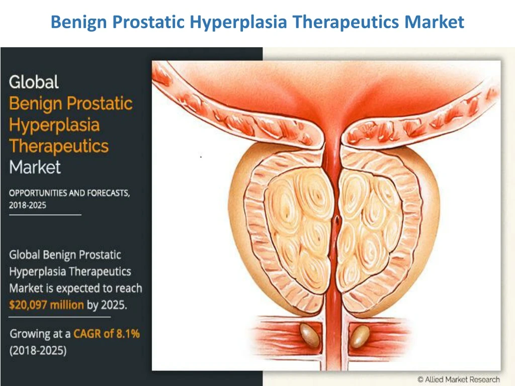 benign prostatic hyperplasia therapeutics market