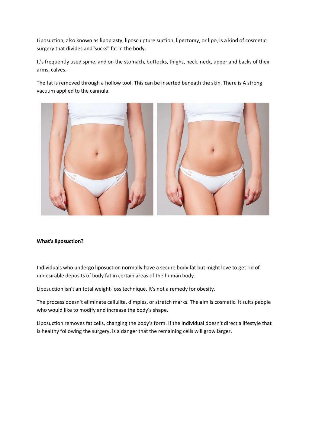 liposuction also known as lipoplasty