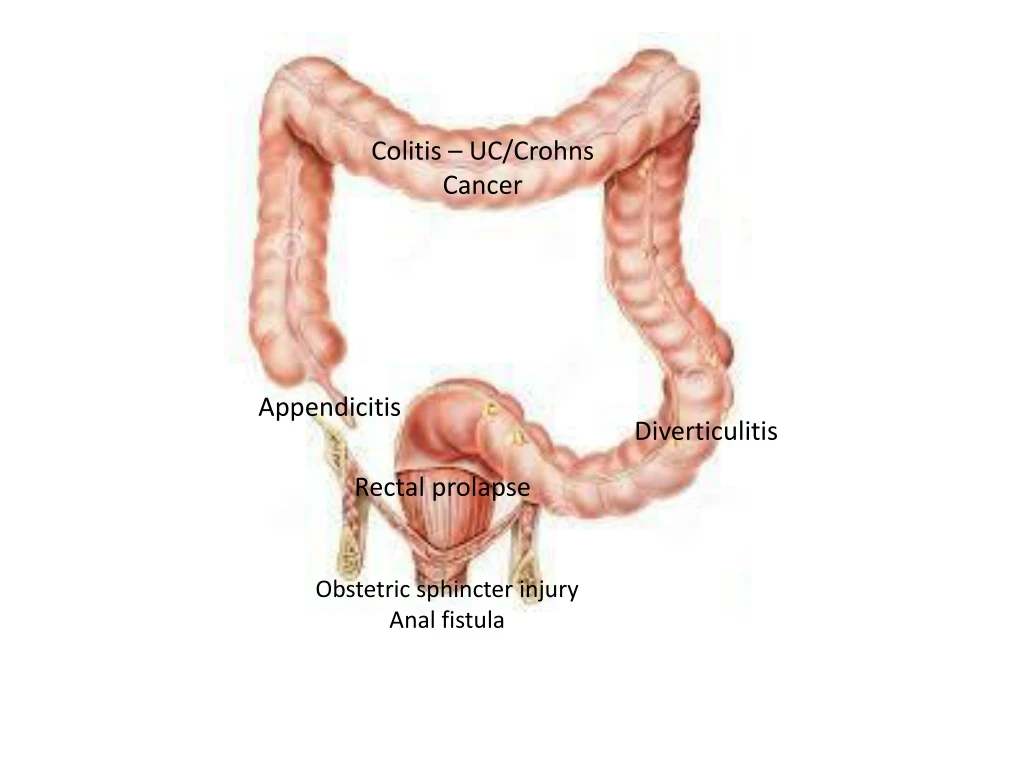 colitis uc crohns cancer