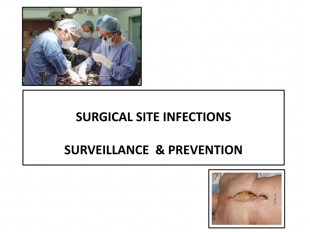 surgical site infections surveillance prevention