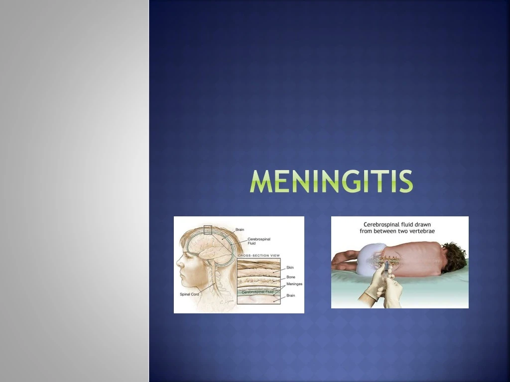 meningitis