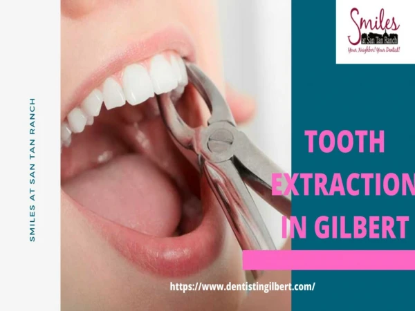 Tooth Extractions In Gilbert