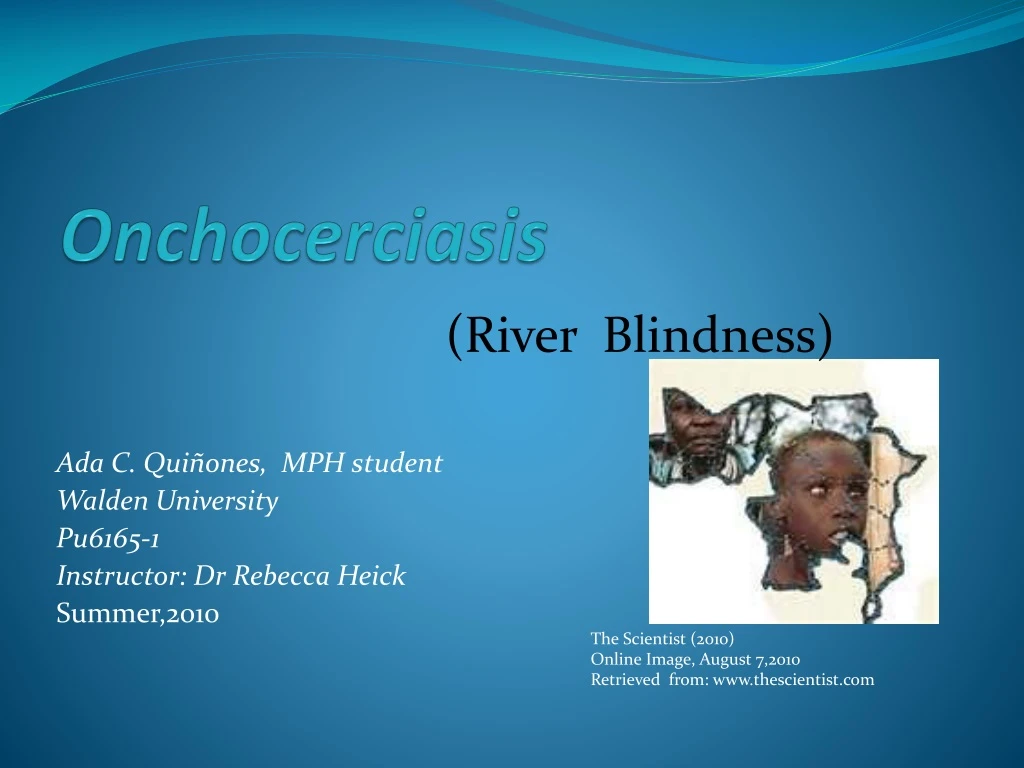 onchocerciasis