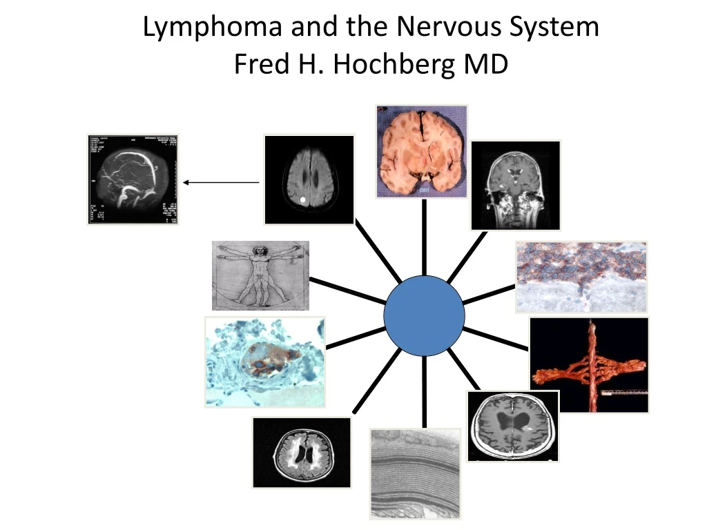 lymphoma and the nervous system fred h hochberg md