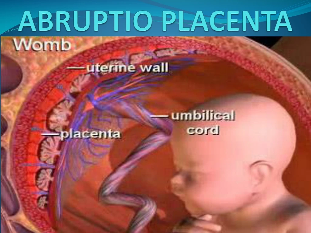 abruptio placenta