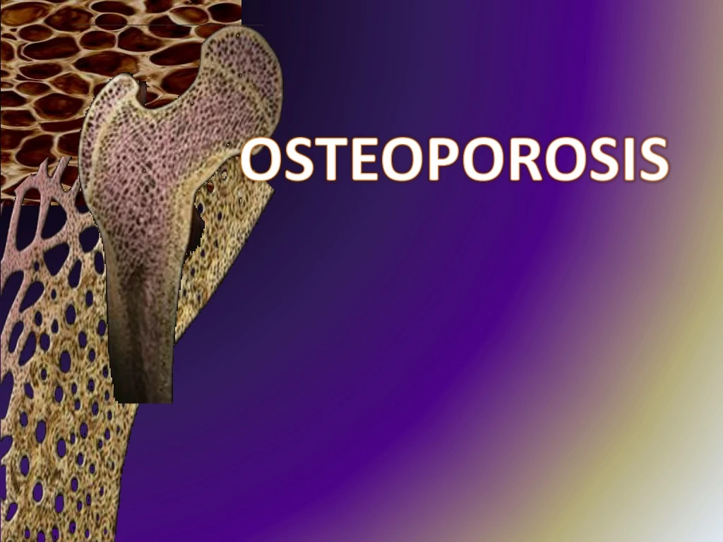 osteoporosis