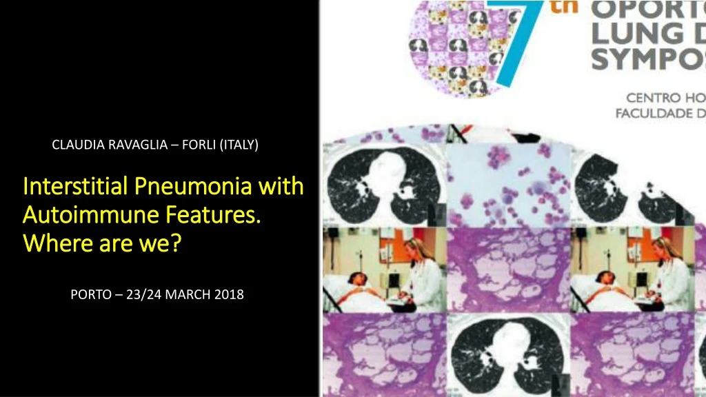 interstitial pneumonia with autoimmune features where are we