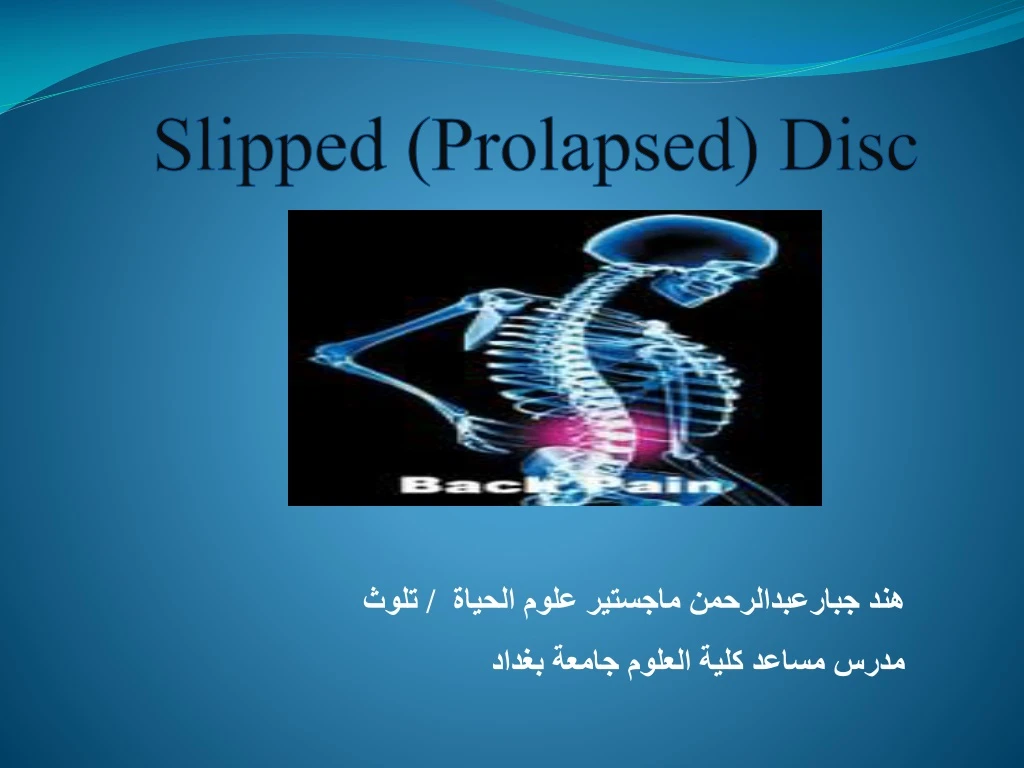 slipped prolapsed disc