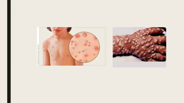 SMALLPOX AND CHICKENPOX