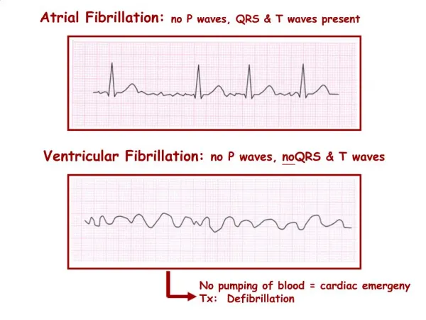 Atrial Fibrillation: no P waves, QRS T waves present