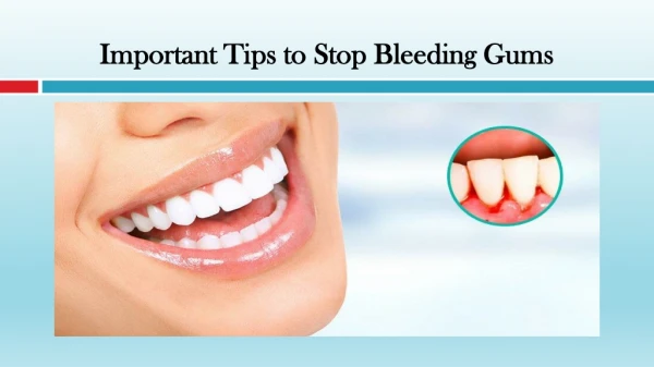 Important Tips to Stop Bleeding Gums